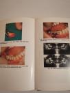 OPERATIVE EXTRACTION OF WISDOM TEETH
