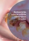 Restauracija zuba sa velikim oštećenjima krunice Restauracija zuba sa velikim oštećenjima krunice